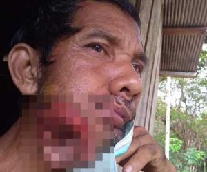 Butuh Bantuan, Mihal Berjuang Melawan Penyakit Langka