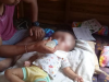 Bayi Hydrosepalus Butuh Bantuan